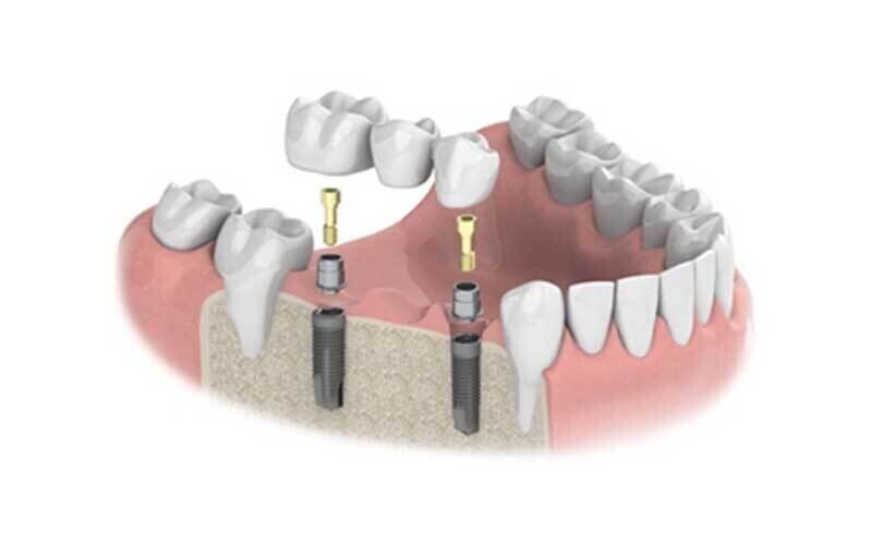 Treatment Options