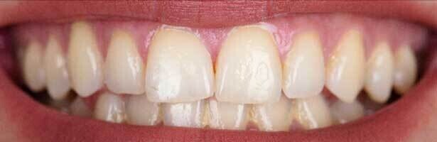 Whitening
