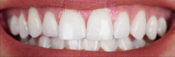 Whitening