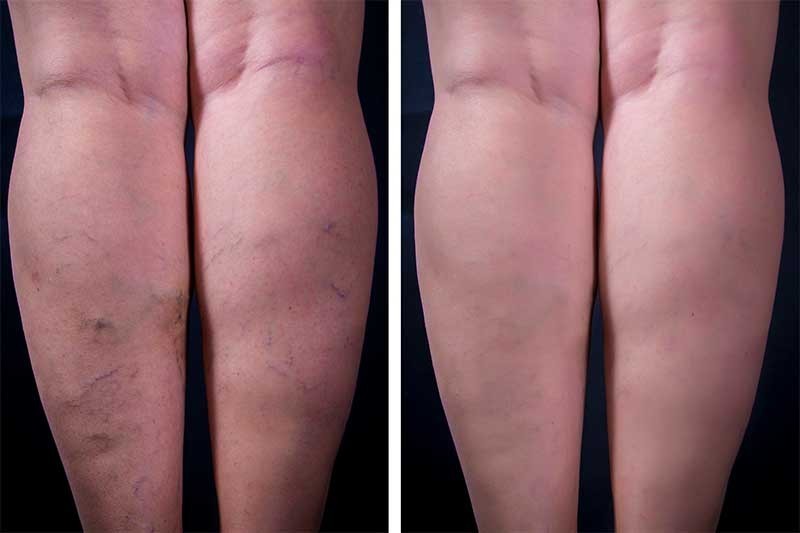 Nottingham Laser Treatments, Nottingham Laser Hair Removal, Shani Beauty Nottingham